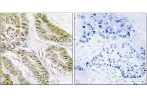 Immunohistochemistry analysis of paraffin-embedded human lung carcinoma tissue, using BAX Antibody. (BAX Antikörper  (AA 80-129))