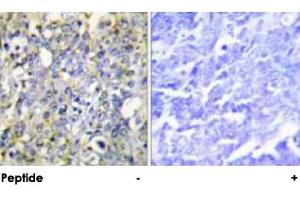 Immunohistochemical analysis of paraffin-embedded human lung carcinoma tissue using IGFBP3 polyclonal antibody . (IGFBP3 Antikörper  (Ser183))