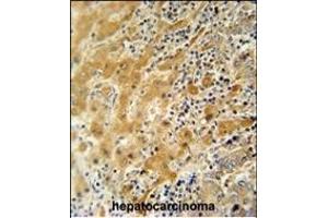 NUS antibody (N-term) 11000a immunohistochemistry analysis in formalin fixed and paraffin embedded human hepatocarcinoma followed by peroxidase conjugation of the secondary antibody and DAB staining.