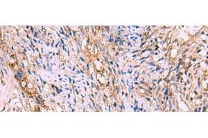 Immunohistochemistry of paraffin-embedded Human cervical cancer tissue using GALK2 Polyclonal Antibody at dilution of 1:95(x200)