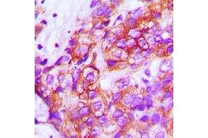 Immunohistochemical analysis of ZP1 staining in human breast cancer formalin fixed paraffin embedded tissue section. (ZP1 Antikörper)