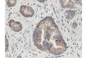 Immunohistochemical staining of paraffin-embedded Adenocarcinoma of Human colon tissue using anti-LGR5 mouse monoclonal antibody. (LGR5 Antikörper  (AA 250-550))