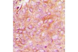 Immunohistochemical analysis of STMN1 (pS16) staining in human breast cancer formalin fixed paraffin embedded tissue section. (Stathmin 1 Antikörper  (N-Term, pSer16))