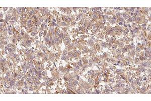 ABIN6279695 at 1/100 staining Human Melanoma tissue by IHC-P. (S100A7 Antikörper  (C-Term))