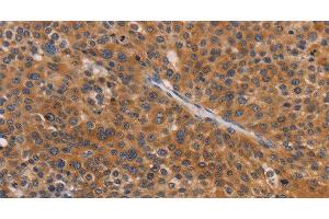Immunohistochemistry of paraffin-embedded Human liver cancer tissue using NCR1 Polyclonal Antibody at dilution 1:30 (NCR1 Antikörper)