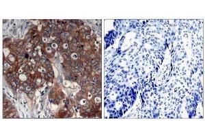 Immunohistochemical analysis of paraffin- embedded human breast carcinoma tissue using HER2 (Ab-877) antibody (E021070). (ErbB2/Her2 Antikörper)