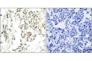 Immunohistochemistry analysis of paraffin-embedded human breast carcinoma, using Chk1 (Phospho-Ser345) Antibody. (CHEK1 Antikörper  (pSer345))