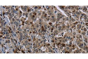 Immunohistochemistry of paraffin-embedded Human liver cancer tissue using CD42b Polyclonal Antibody at dilution 1:50 (CD42b Antikörper)