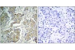 Immunohistochemistry analysis of paraffin-embedded human breast carcinoma, using VEGFR2 (Phospho-Tyr1214) Antibody. (VEGFR2/CD309 Antikörper  (pTyr1214))