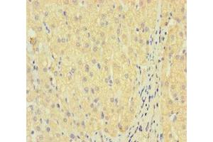 Immunohistochemistry of paraffin-embedded human liver cancer using ABIN7158295 at dilution of 1:100 (LAIR2 Antikörper  (AA 22-152))