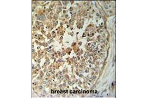 T Antibody (C-term) (ABIN653764 and ABIN2843060) IHC analysis in formalin fixed and paraffin embedded breast carcinoma followed by peroxidase conjugation of the secondary antibody and DAB staining. (STING/TMEM173 Antikörper  (C-Term))