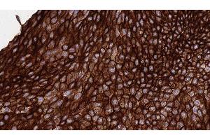 ABIN6276370 at 1/100 staining Human urothelial cancer tissue by IHC-P.