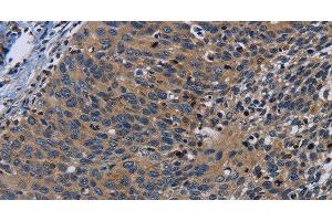 Immunohistochemistry of paraffin-embedded Human cervical cancer tissue using PCDHB15 Polyclonal Antibody at dilution 1:50 (PCDHB15 Antikörper)