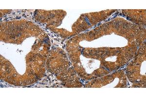 Immunohistochemistry of paraffin-embedded Human cervical cancer tissue using GATA6 Polyclonal Antibody at dilution 1:35 (GATA6 Antikörper)