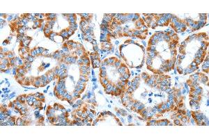 Immunohistochemistry of paraffin-embedded Human thyroid cancer tissue using ALDH5A1 Polyclonal Antibody at dilution 1:60 (ALDH5A1 Antikörper)