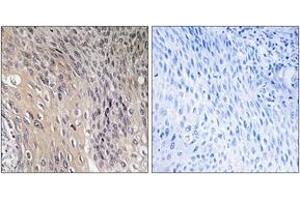 Immunohistochemistry analysis of paraffin-embedded human cervix carcinoma, using ARHGDIA (Phospho-Ser174) Antibody. (ARHGDIA Antikörper  (pSer174))