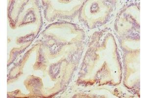 Immunohistochemistry of paraffin-embedded human prostate cancer using ABIN7145599 at dilution of 1:100 (Biliverdin Reductase Antikörper  (AA 1-296))