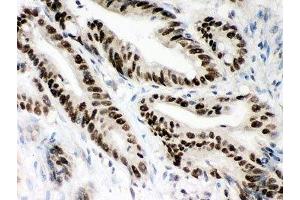 IHC-P: MSH2 antibody testing of human intestine cancer tissue (MSH2 Antikörper  (AA 337-583))