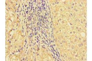 Immunohistochemistry of paraffin-embedded human liver cancer using ABIN7161686 at dilution of 1:100 (GBA2 Antikörper  (AA 656-867))