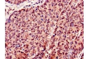 Immunohistochemistry of paraffin-embedded human ovarian cancer using ABIN7155434 at dilution of 1:100 (Histone H3.3 Antikörper  (AA 2-136))