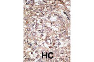 Formalin-fixed and paraffin-embedded human hepatocellular carcinoma tissue reacted with Tlr1 polyclonal antibody  , which was peroxidase-conjugated to the secondary antibody, followed by AEC staining.