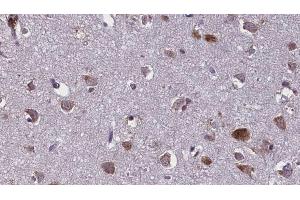 ABIN6274927 at 1/100 staining Human brain cancer tissue by IHC-P. (BCAS4 Antikörper)