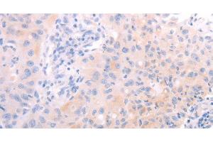 Immunohistochemistry of paraffin-embedded Human lung cancer tissue using AMH Polyclonal Antibody at dilution 1:30 (AMH Antikörper)