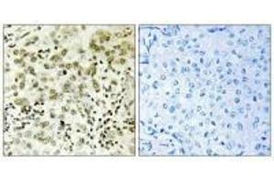 Immunohistochemistry analysis of paraffin-embedded human breast carcinoma tissue, using CTDSP1 antibody. (CTDSP1 Antikörper  (N-Term))
