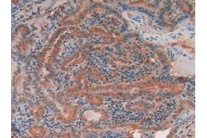IHC-P analysis of Human Thyroid Cancer Tissue, with DAB staining. (TEK Antikörper  (AA 1-116))