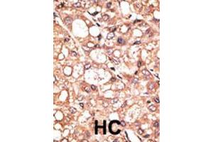 Formalin-fixed and paraffin-embedded human hepatocellular carcinoma tissue reacted with AOF2 polyclonal antibody , which was peroxidase-conjugated to the secondary antibody, followed by DAB staining. (LSD1 Antikörper  (Internal Region))