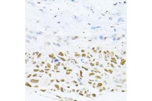 Immunohistochemistry of paraffin-embedded human lung cancer using DNMT1 antibody (ABIN7266810) at dilution of 1:100 (40x lens). (DNMT1 Antikörper  (AA 1-270))