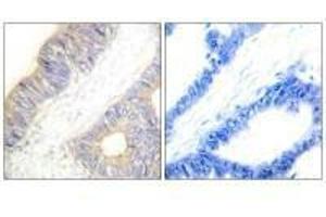 Immunohistochemistry analysis of paraffin-embedded human colon carcinoma tissue using Stefin A antibody. (CSTA Antikörper  (C-Term))