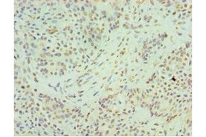 Immunohistochemistry of paraffin-embedded human breast cancer using ABIN7155133 at dilution of 1:100
