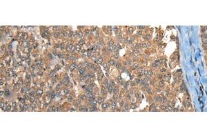 Immunohistochemistry of paraffin-embedded Human liver cancer tissue using C1R Polyclonal Antibody at dilution of 1:40(x200) (C1R Antikörper)