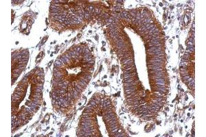 IHC-P Image Immunohistochemical analysis of paraffin-embedded human colon carcinoma, using Vitronectin, antibody at 1:500 dilution. (Vitronectin Antikörper)