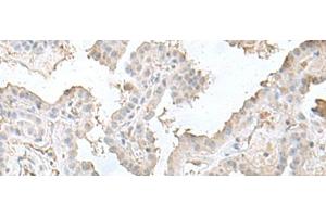 Immunohistochemistry of paraffin-embedded Human thyroid cancer tissue using LSM10 Polyclonal Antibody at dilution of 1:50(x200) (LSM10 Antikörper)