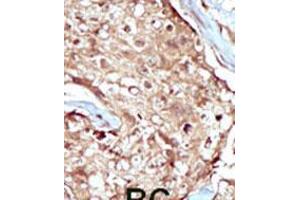 Formalin-fixed and paraffin-embedded human cancer tissue reacted with the primary antibody, which was peroxidase-conjugated to the secondary antibody, followed by AEC staining. (PAPSS2 Antikörper  (C-Term))