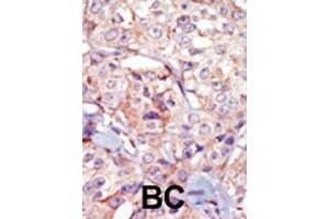 Formalin-fixed and paraffin-embedded human cancer tissue reacted with the primary antibody, which was peroxidase-conjugated to the secondary antibody, followed by AEC staining. (GSG2 Antikörper  (AA 323-352))