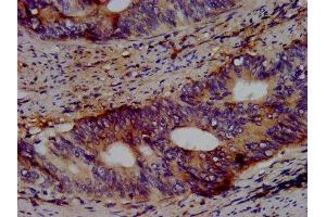 IHC image of ABIN7164019 diluted at 1:500 and staining in paraffin-embedded human colon cancer performed on a Leica BondTM system. (KCNV2 Antikörper  (AA 1-155))