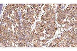 ABIN6278586 at 1/100 staining Human Melanoma tissue by IHC-P. (KLHL3 Antikörper  (N-Term))