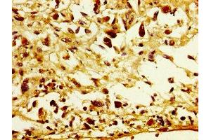 IHC image of ABIN7153729 diluted at 1:300 and staining in paraffin-embedded human melanoma performed on a Leica BondTM system.