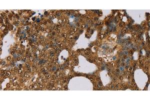 Immunohistochemistry of paraffin-embedded Human cervical cancer using PSMC2 Polyclonal Antibody at dilution of 1:30 (PSMC2 Antikörper)