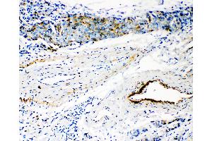 Anti-HYAL3 antibody, IHC(P) IHC(P): Human Mammary Cancer Tissue (HYAL3 Antikörper  (C-Term))