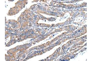 The image on the left is immunohistochemistry of paraffin-embedded Human esophagus cancer tissue using ABIN7193094(ZFAND2A Antibody) at dilution 1/30, on the right is treated with synthetic peptide. (ZFAND2A Antikörper)