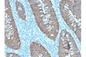 Formalin-fixed, paraffin-embedded human Colon Carcinoma stained with EpCAM Rabbit Recombinant Monoclonal Antibody (EGP40/2571R). (Rekombinanter EpCAM Antikörper  (Extracellular Domain))