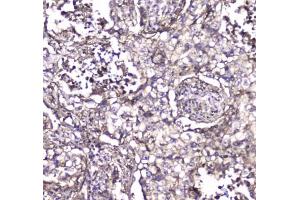 IHC testing of FFPE human rectal cancer tissue with S100A10 antibody at 1ug/ml. (S100A10 Antikörper)