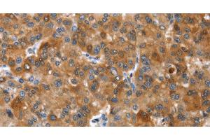 Immunohistochemistry of paraffin-embedded Human liver cancer tissue using NOD2 Polyclonal Antibody at dilution 1:40 (NOD2 Antikörper)