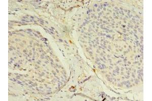 Immunohistochemistry of paraffin-embedded human cervical cancer using ABIN7160712 at dilution of 1:100 (NAT8 Antikörper  (AA 64-227))