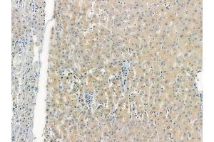 ABIN6263860 and ABIN6272770 at 1/100 staining human hepatocellular carcinoma by IHC-P.
