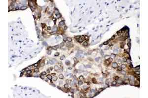 Anti- KIN Picoband antibody, IHC(P) IHC(P): Human Oesophagus Squama Cancer Tissue (KIN Antikörper  (AA 3-202))